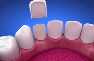 Porcelain Or Composite Veneers