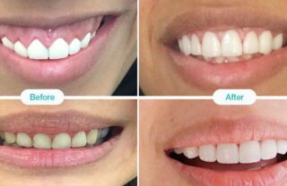 Gum Contouring Treatment