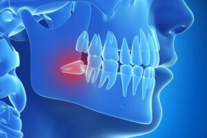 Wisdom Tooth Extraction