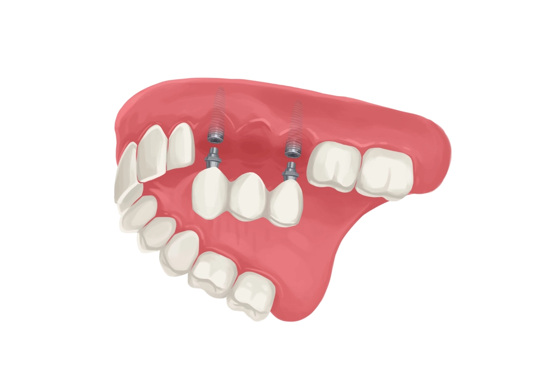 Alternatives to Dental Implants