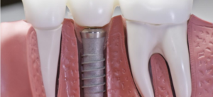 full-mouth dental implants