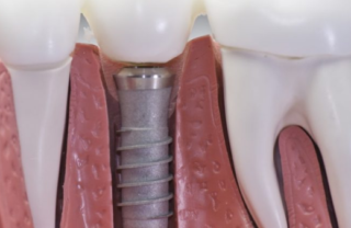 Dental implant failure: causes, prevention, and treatment options