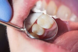 Preserving your tooth’s structure 