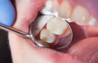 Preserving your tooth’s structure