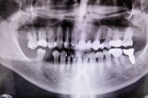 Tooth Removal: When extraction becomes necessary