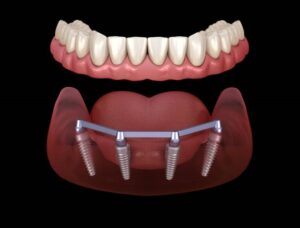 Dental Implants