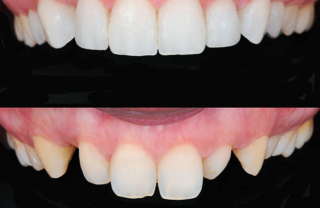 replacing veneers