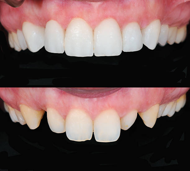 replacing veneers