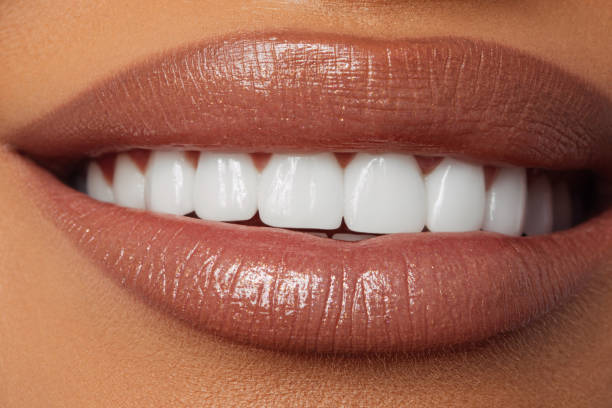 Teeth Staining with Teeth Whitening