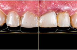 Alignment Before Veneer Placement