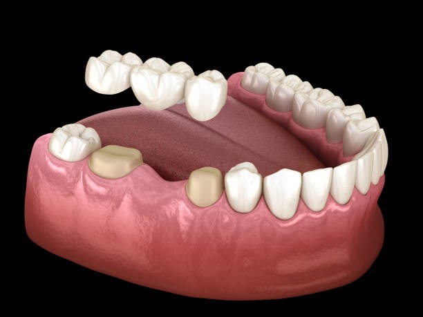 Dental Bridges