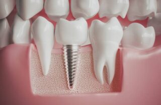 Dental Implants