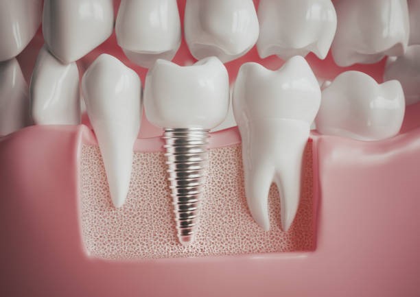 Dental Implants