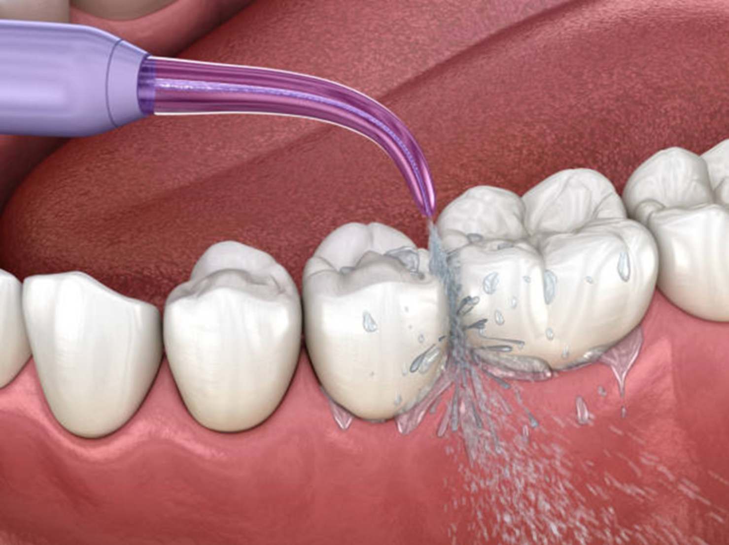 Water Flossers in Modern Oral Hygiene